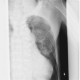 Rib fracture, lung contusion, hematoma, pneumothorax, hydropneumothorax: X-ray - Plain radiograph